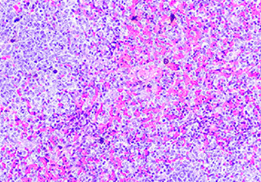 Histologische Aufnahme eines „follikulären Lymphoms“