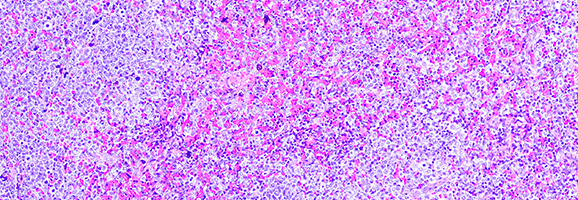 Histologische Aufnahme eines „follikulären Lymphoms“