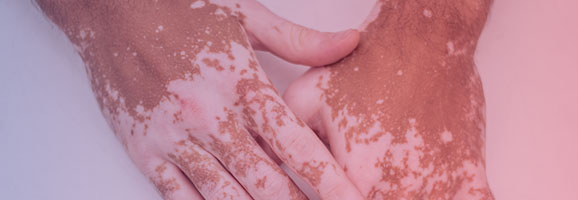 Foto „Autoimmune Entzündungsreaktion bei Vitiligo“ zeigt Haut mit Depigmentierungsarealen
